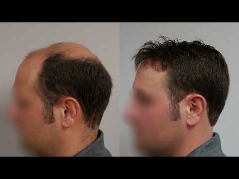 Intro to Hair Replacement Certification